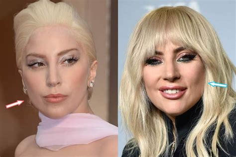 lady gaga surgery|Lady Gaga Plastic Surgery